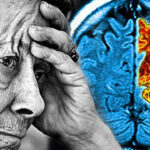 Alzheimer İçin Engelli Raporu Yüzdesi Kaçtır