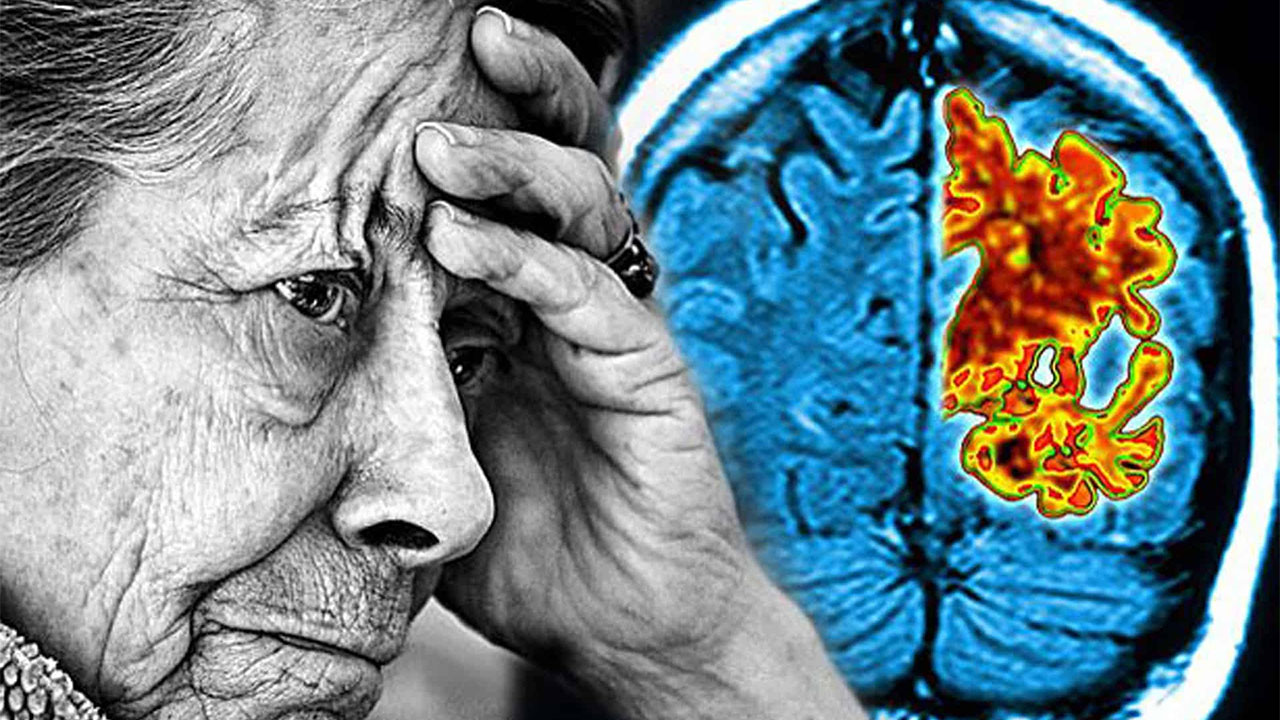 Alzheimer İçin Engelli Raporu Yüzdesi Kaçtır